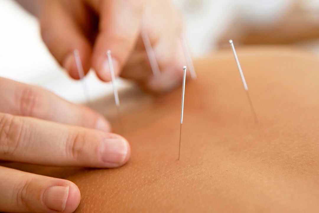 Akupunktur untuk meningkatkan potensi